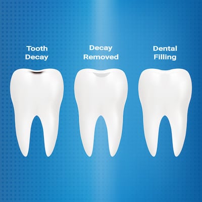 mercury free dental filling