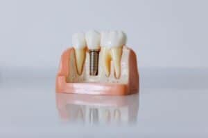 5 Reasons to Consider Getting Dental Implants?