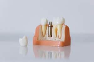 5 Reasons to Consider Getting Dental Implants?