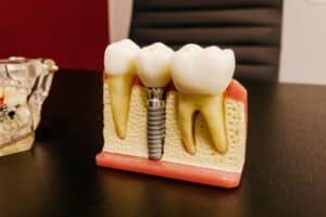 5 Reasons to Consider Getting Dental Implants?