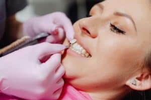 DIY vs. Professional Teeth Whitening